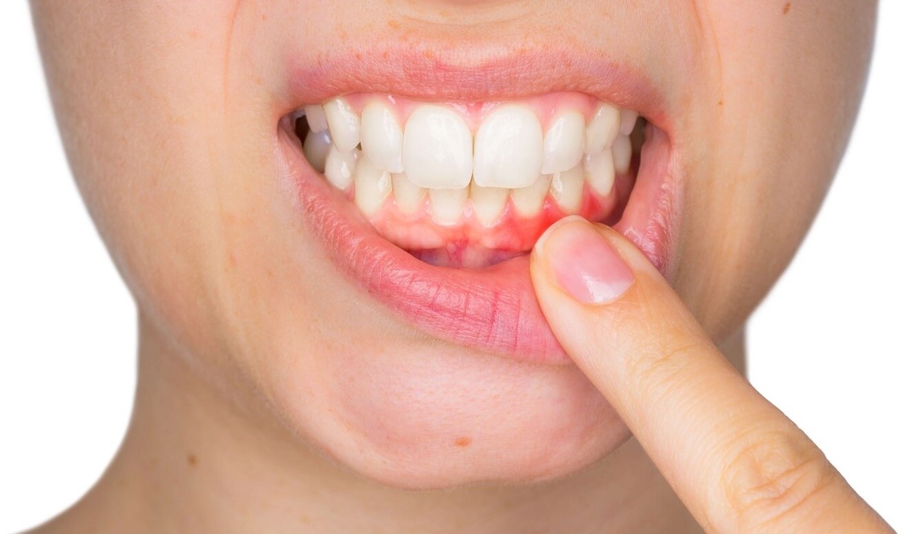 Best-Cure-for-Gum-Disease-Newmarket-Dentist-Keep-28-Dental-Clinic