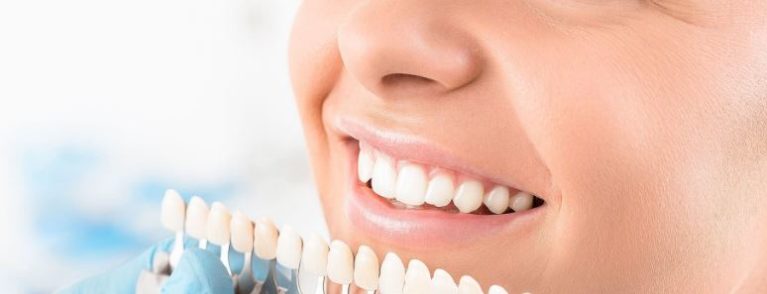 Dental-Veneers-Costs-And-Other-Things-You-Need-To-Know