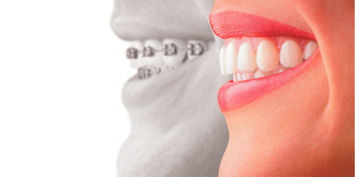 Learn-These-Things-Prior-To-Having-Your-Invisalign-Aligners