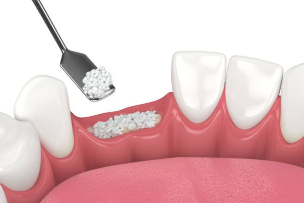 bone grafting near you
