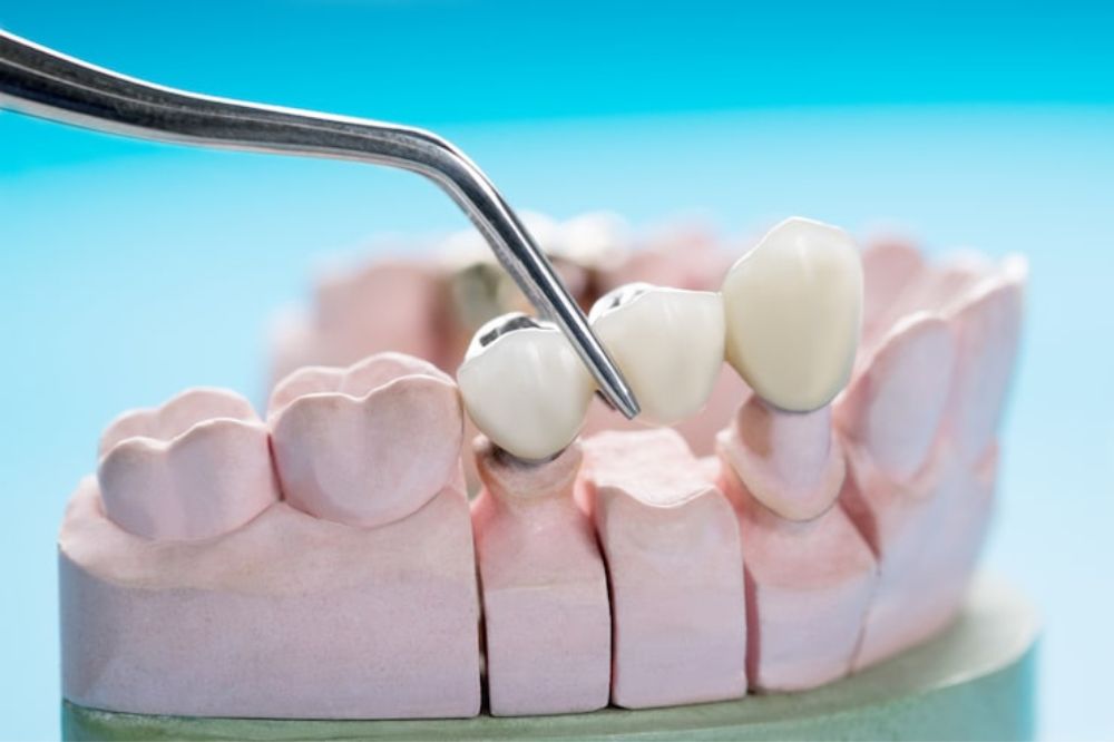 dental bridges near you
