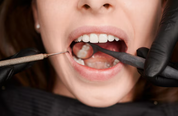 dental sealants newmarket
