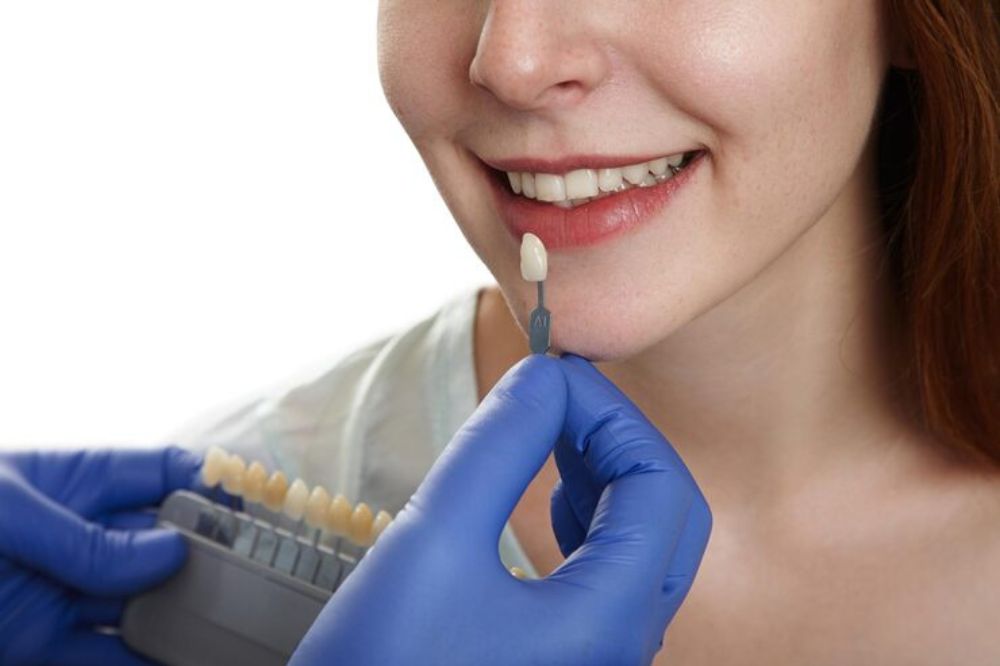 dental veneers in newmarket