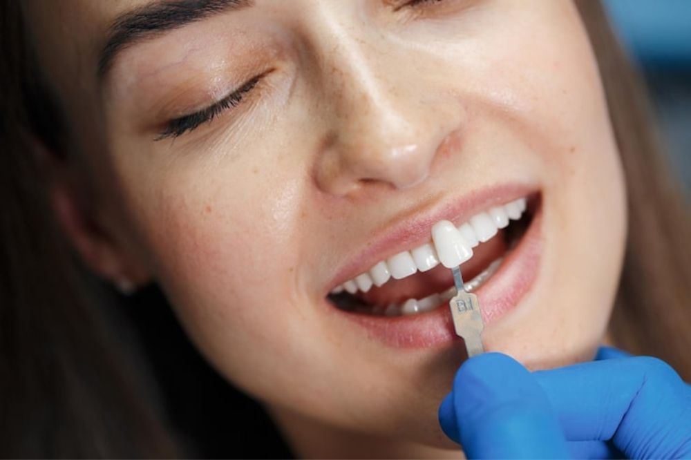 dental veneers near you