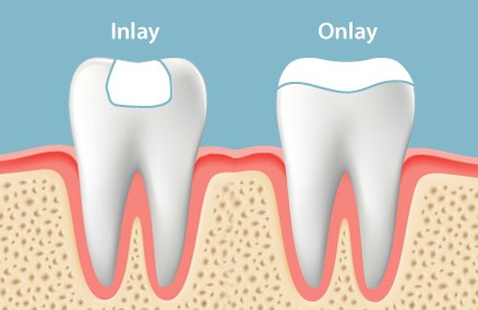 inlays-and-onlays-fillings-newmarket-newmarket-dentists-keep28-dental-clinic