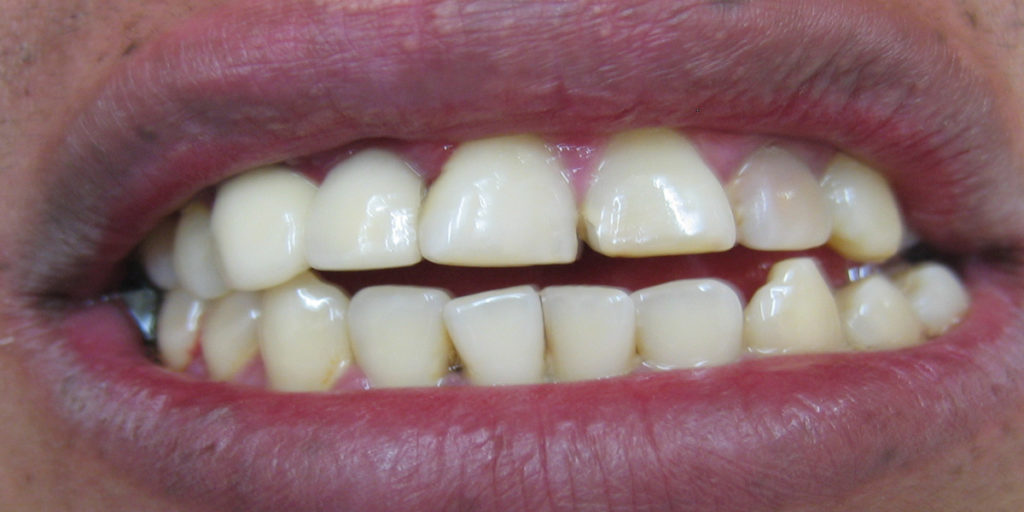 How To Stop Clenching Teeth At Night Keep 28 Dental