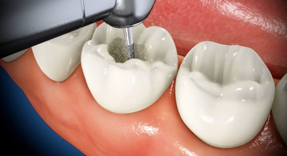 What is a Cavity Filling?