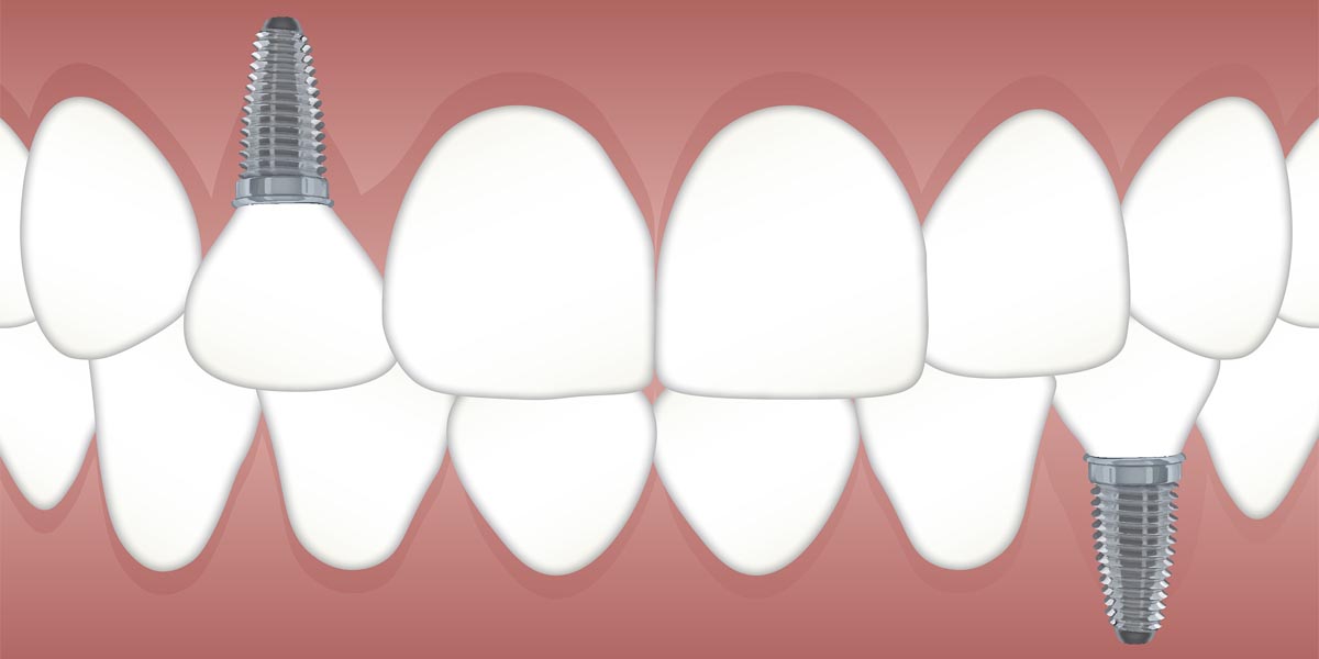 why-should-you-choose-dental-implants-over-dentures