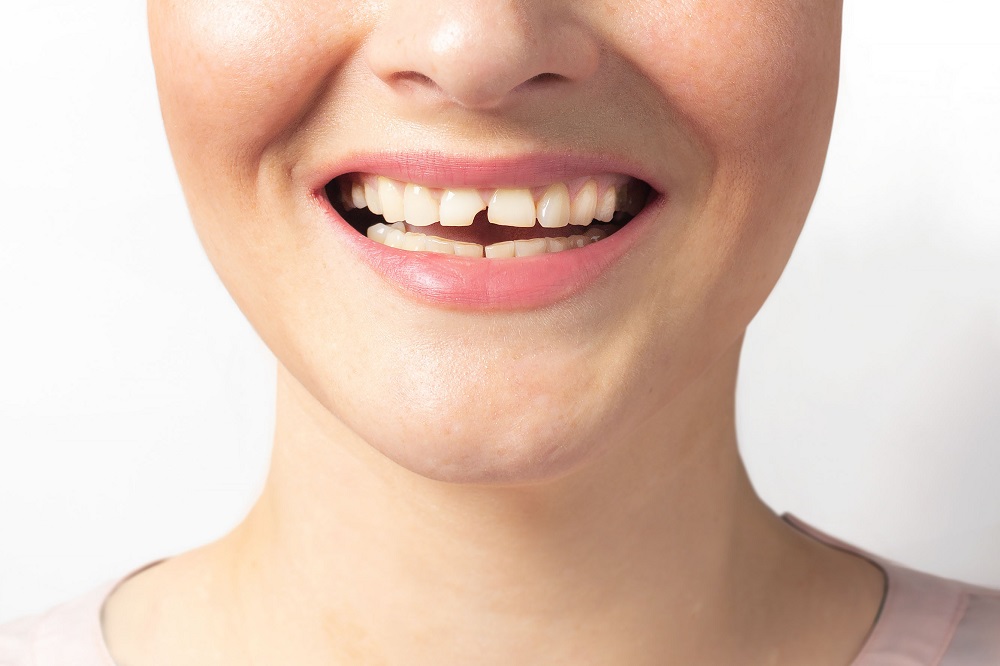 woman having broken tooth