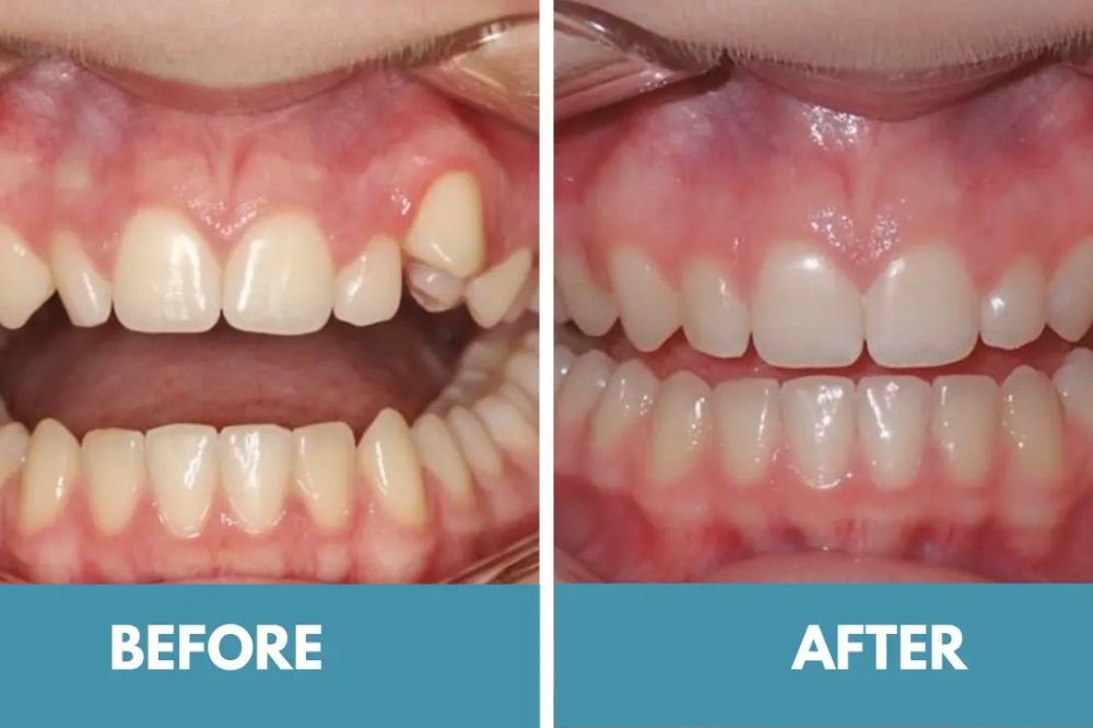 invisalign before and after