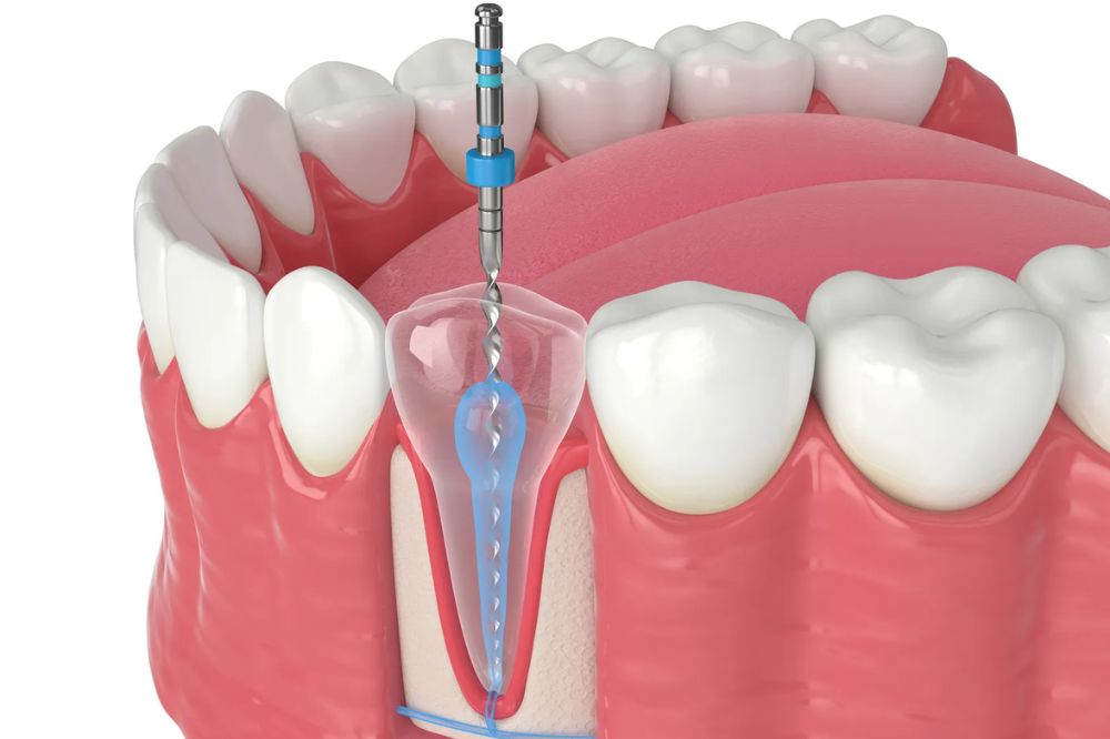 root canal therapy near you