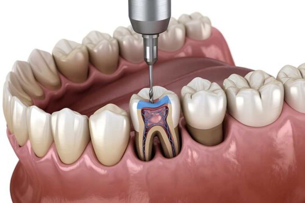 root canal therapy near you