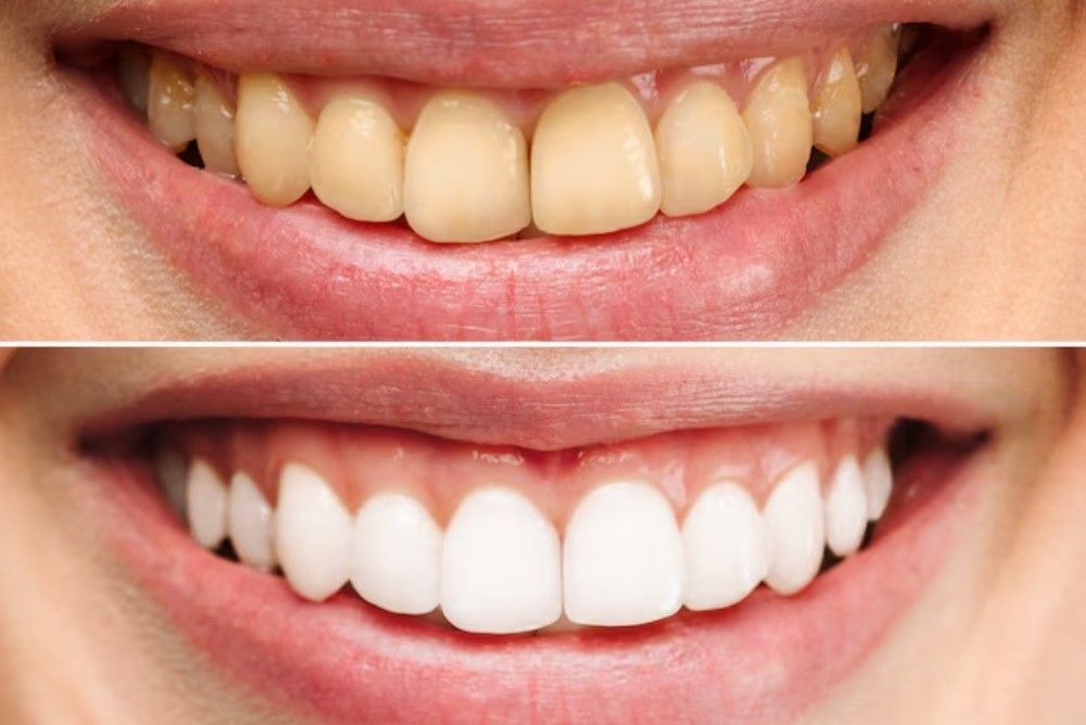 Teeth Whitening in Newmarket