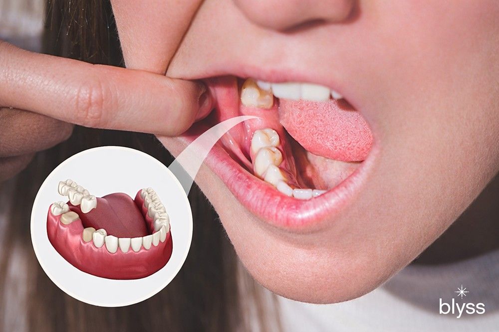 Are Dental Bridges Good For Missing Teeth?